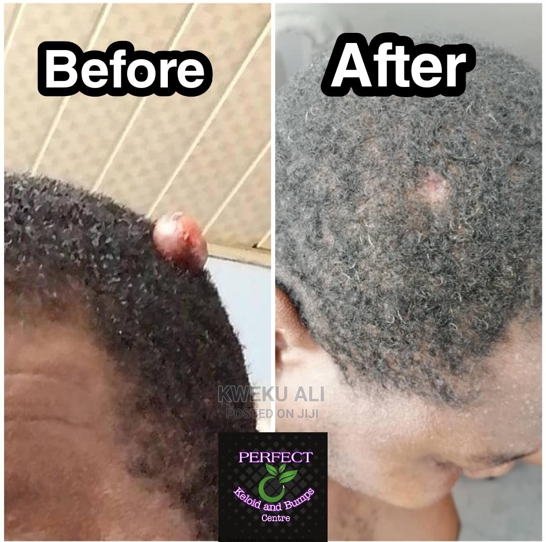 Keloid And Bumps Treatment in Spintex Health & Beauty Services, Kweku