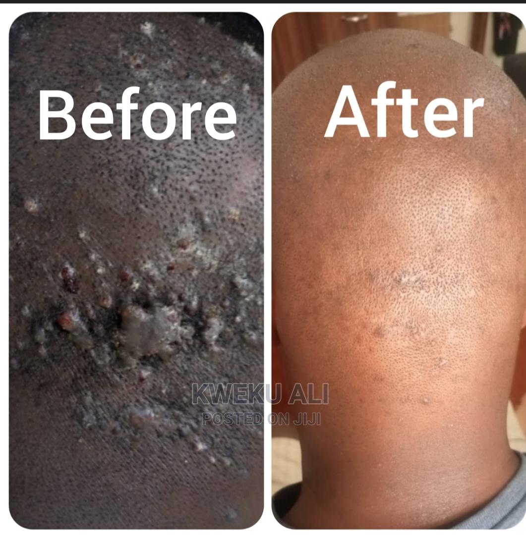 Keloid And Bumps Treatment in Spintex Health & Beauty Services, Kweku