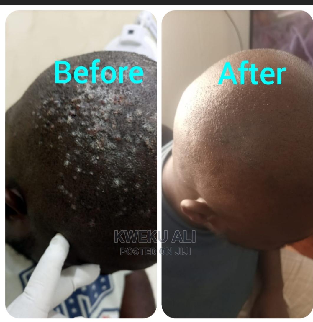 Keloid And Bumps Treatment in Spintex Health & Beauty Services, Kweku